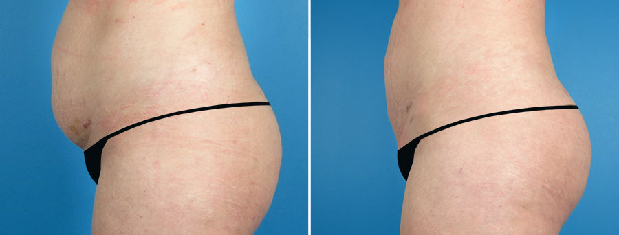 cosmetic fat transfer